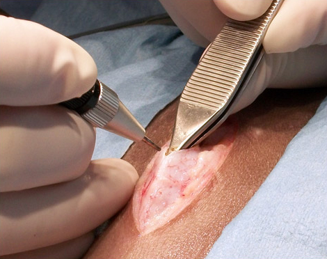 LaserSurgery Laser Surgery